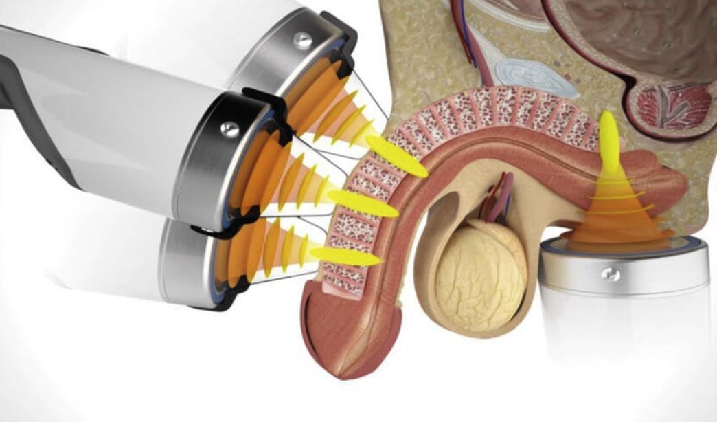 ESWT Tedavisi Faydaları